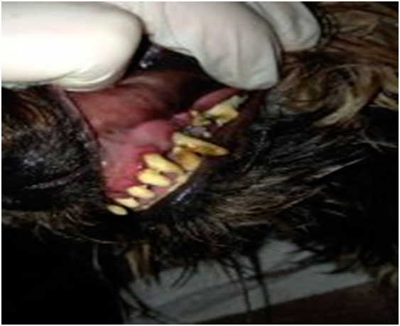 гипоплазия зубной эмали